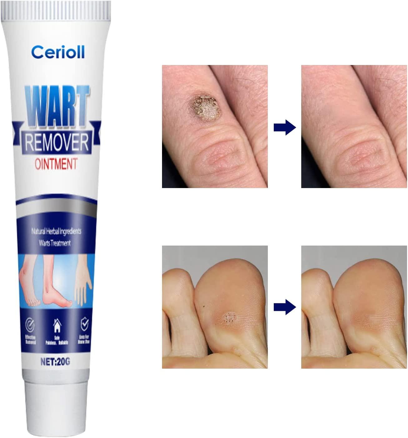 Mụn cóc, Chống mụn cóc ở chân, Không mụn cóc,  góc, Chống mụn cóc ở tay/chân, Chống mụn cóc, Ngừng  mụn cóc, Chống mụn cóc, Chăm sóc mụn cóc/ngô/chân
