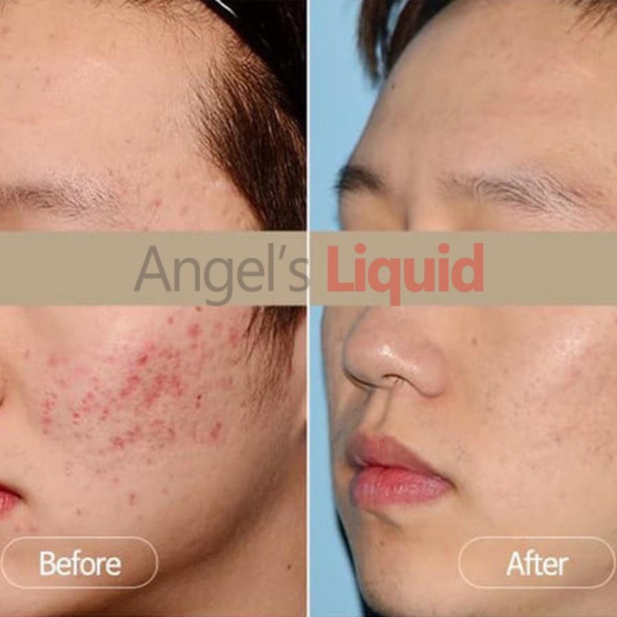 Siêu Tinh Chất Xoá Thâm Đỏ, Mờ Sạm Nám Angel's Liquid Tranexamic Mela Ampoule 30ml