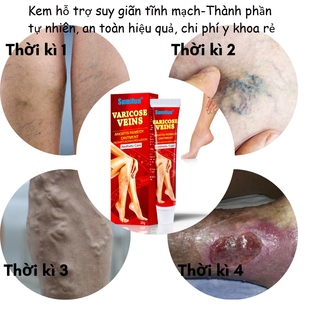 Kem hỗ trợ suy giãn tĩnh mạch do công việc đứng lâu và nhiều, thành phần thảo dược, an toàn và chi phí cực rẻ