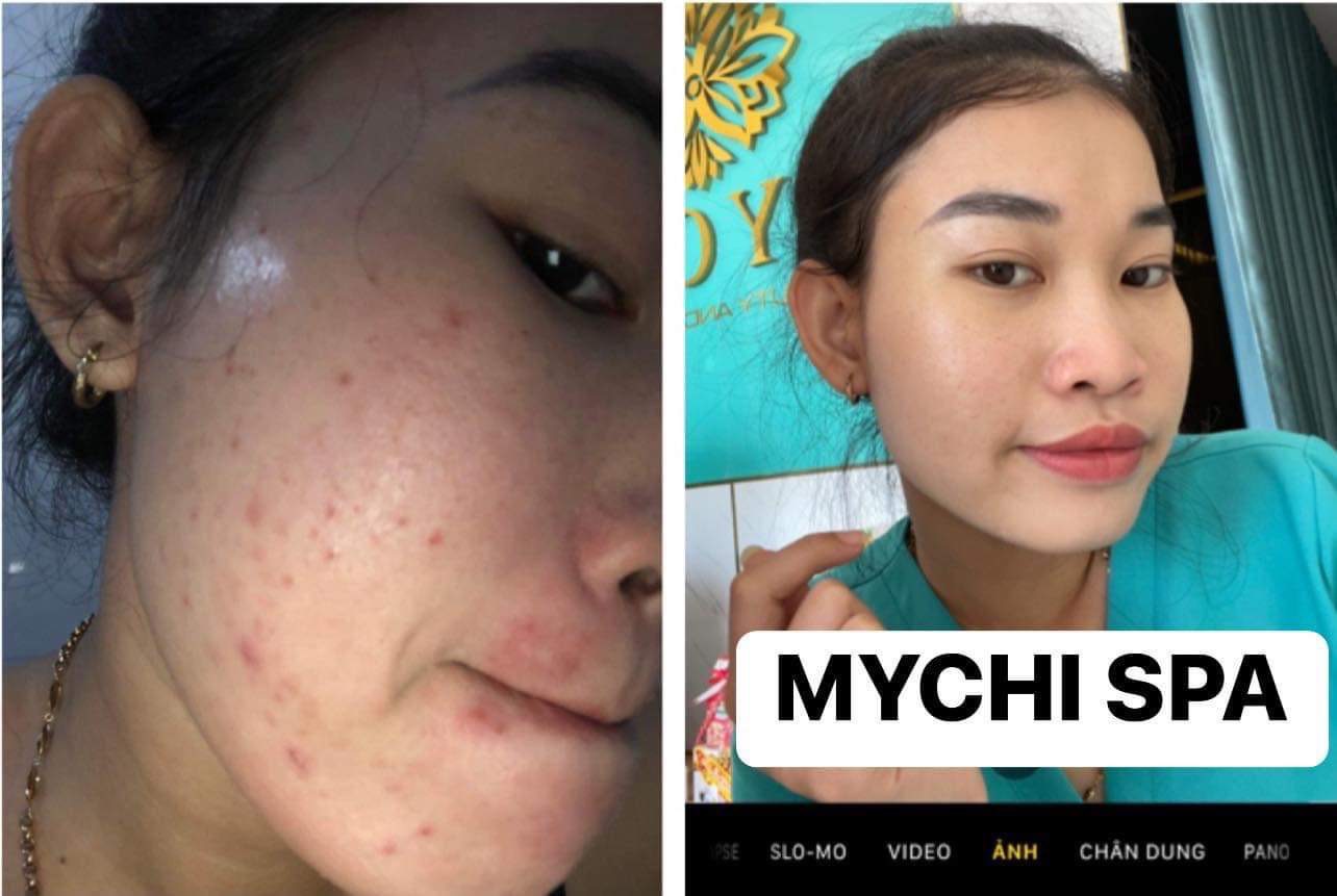 Serum mụn ACNE Mychi