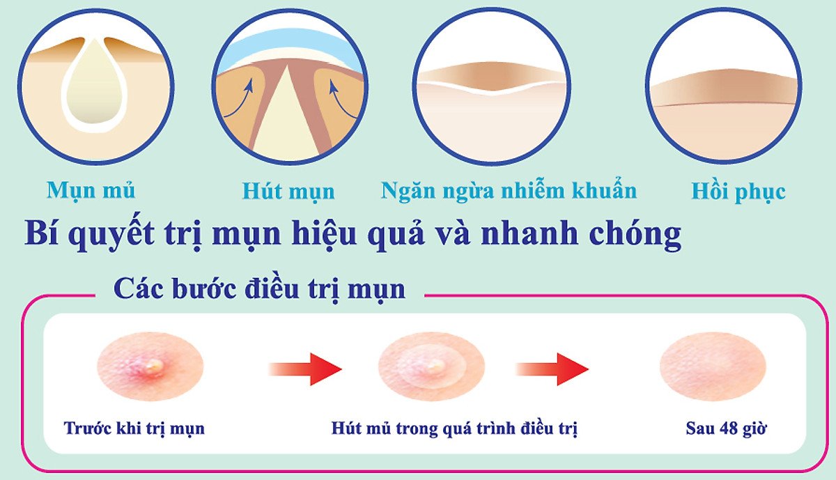 Miếng Dán Mụn, Ngăn Ngừa Sẹo Somaderm Thin (12 miếng)