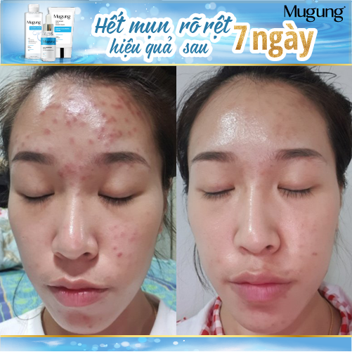 Serum Hoặc Nước Tẩy Trang giảm mụn Mugung 7 ngày hiệu quả giảm mụn đầu đen,mụn bọc Acne Treatment