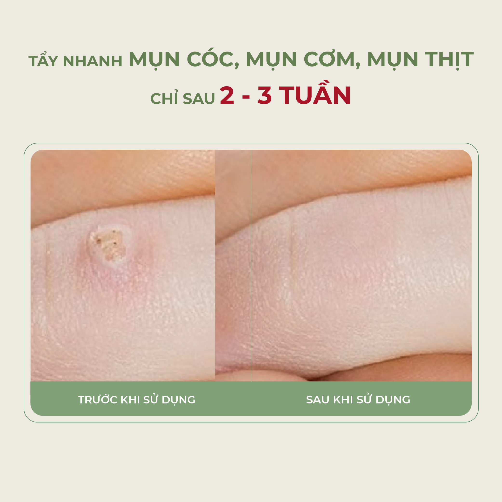 Tinh chất Đu Đủ PAPAYA ABERA 7ml Xử Lý Mụn Cóc, Mụn Cơm, Mụn Thịt Sau 7 Ngày