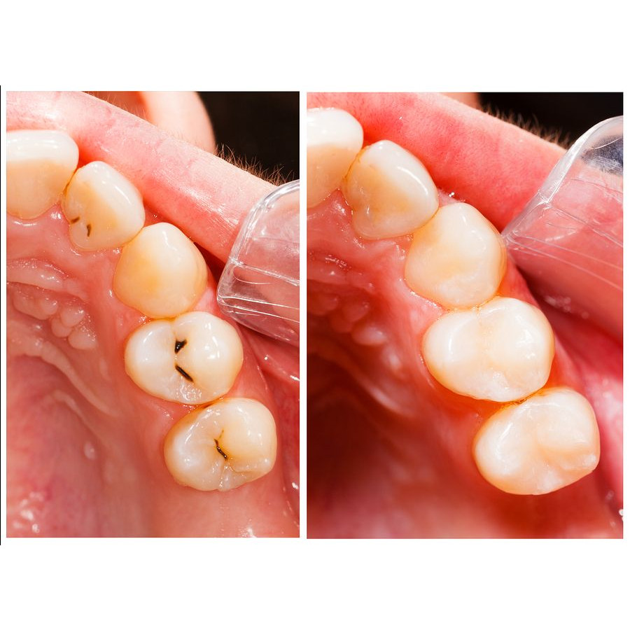 Hình ảnh Hàn trám Răng thẩm mỹ bằng Composite - Nha Khoa Gia Hân