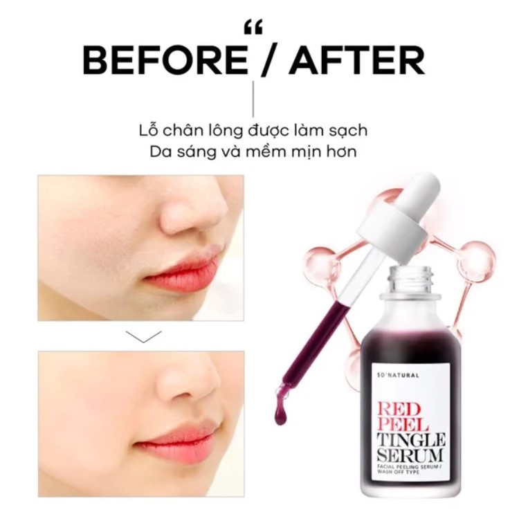 Tinh Chất Tái Tạo Da SoNatural Red Peel Tingle Serum 35ml