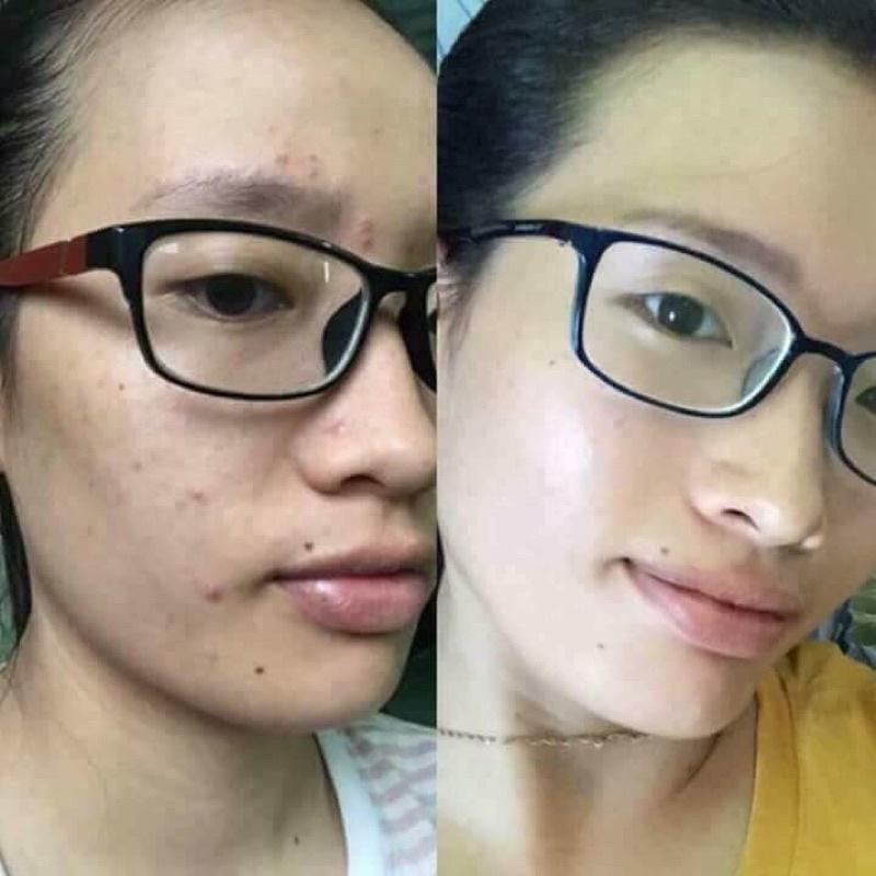 Kem Ngăn Ngừa Mụn Acne DR CELL 30g