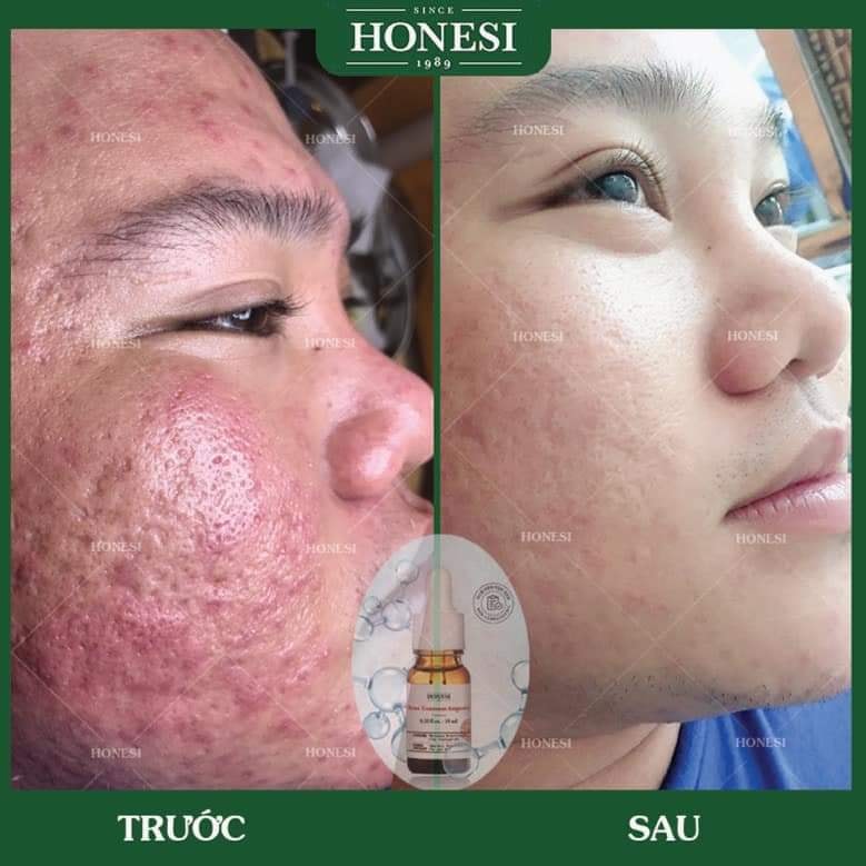 Sét Serum Giảm Mụn Nhanh Lành Tính HONESI Acne Treatment Ampoule - Hàn Quốc