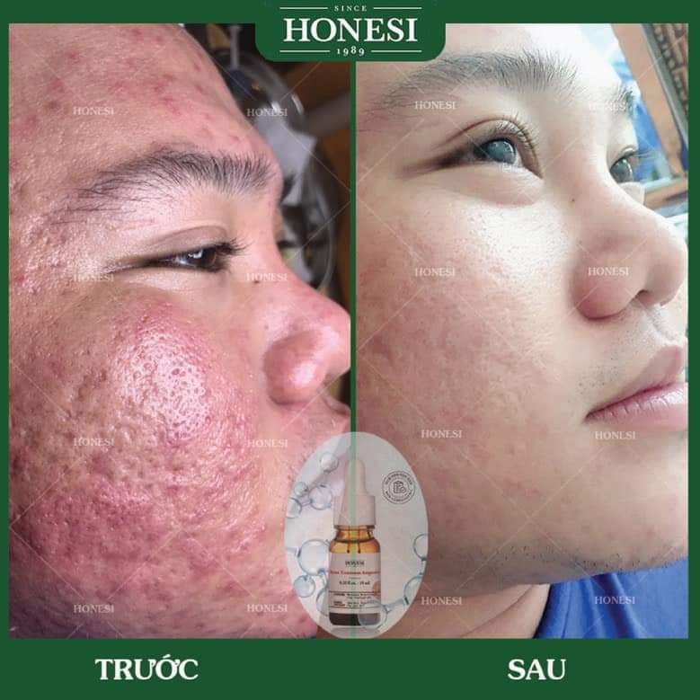 Sét Serum Giảm Mụn Nhanh Lành Tính HONESI Acne Treatment Ampoule (10ml x 5 lọ) - Hàn Quốc