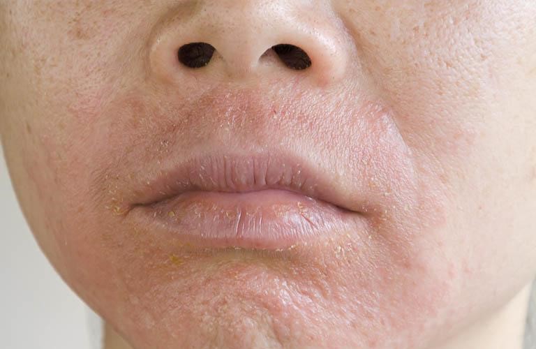 Thảo dược bôi nấm ngứa, tổ đỉa, hắc lào, lang ben, vảy nến, á sừng, zona các vấn đề về da_1 hộp 20 gói