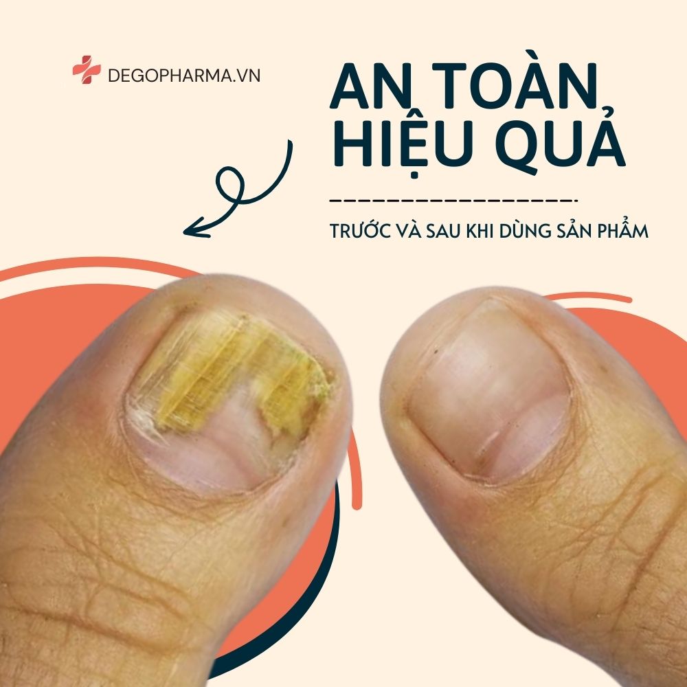 Tinh chất nấm móng Dego Pharma - Giảm nấm móng dứt điểm, giảm sưng ngứa, nuôi dưỡng tái tạo móng mới