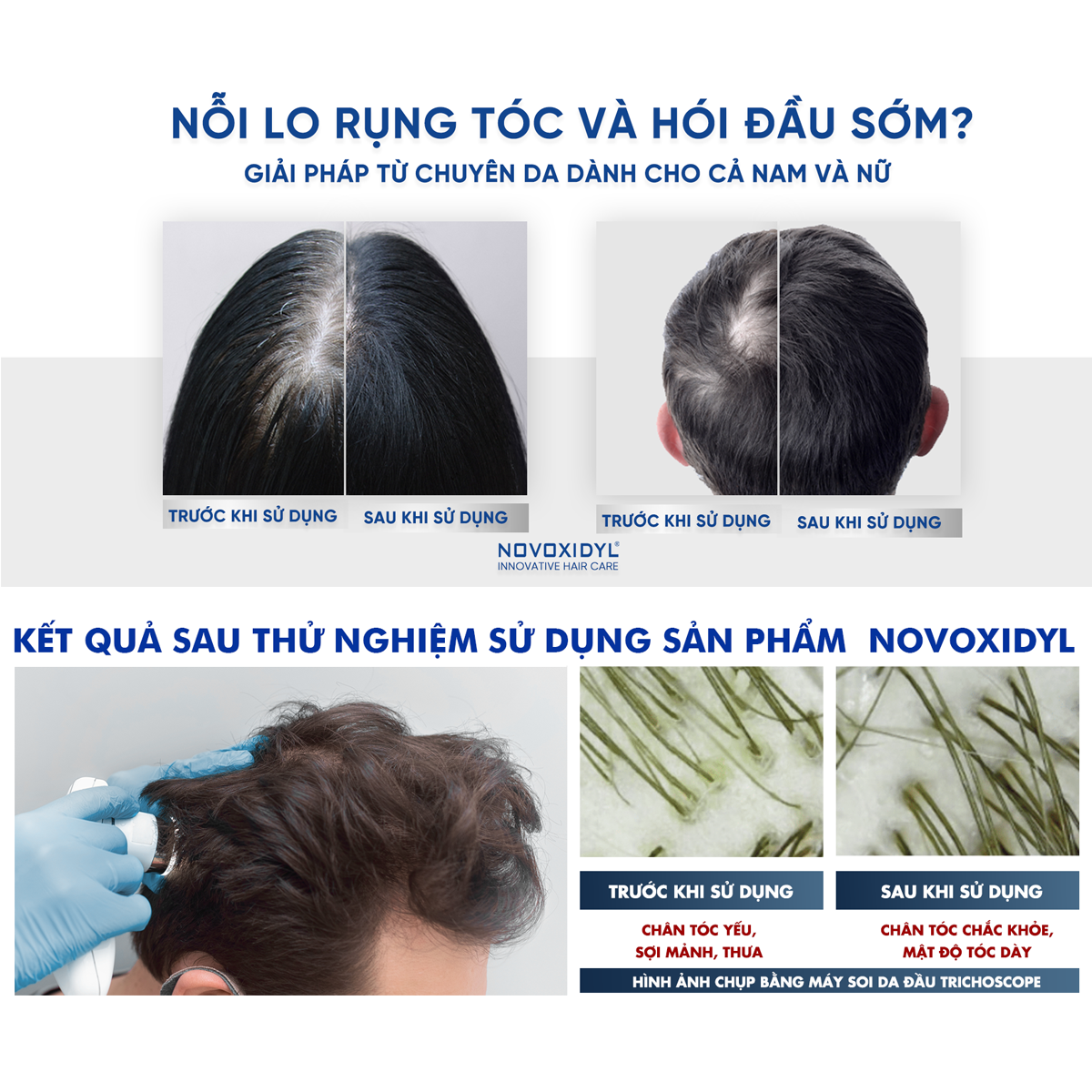 Dầu gội Y Tế Novoxidyl ngăn ngừa rụng tóc, thúc đẩy mọc tóc nhanh chai 200ml
