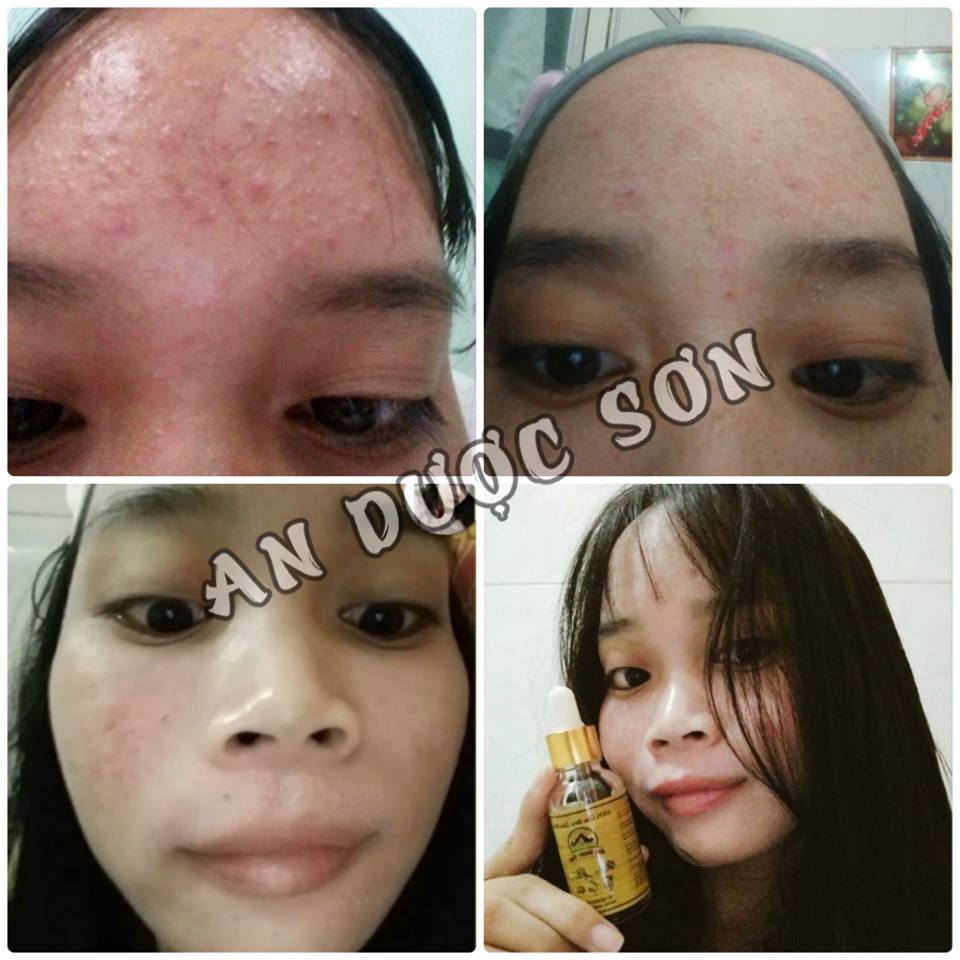 Combo Serum ngừa mụn thâm sẹo rỗ An Dược Sơn 30ml + Bột rửa mặt an dược sơn