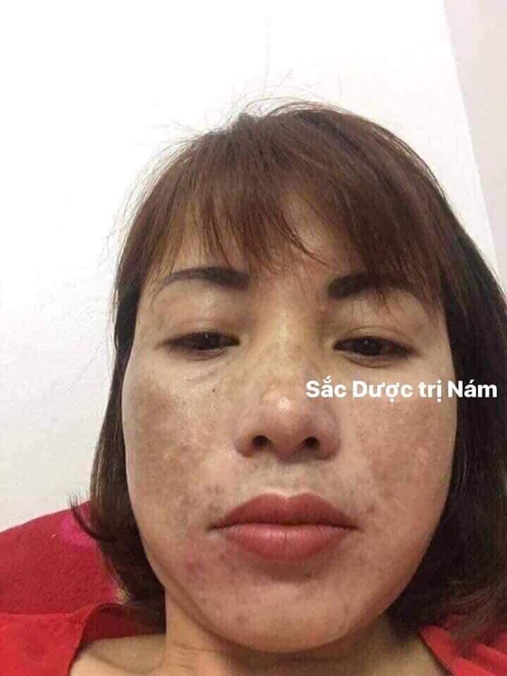 sorry shop nhé. hình ảnh không liên quan. Anh chị em nào bị mụn, nám, sạm, da xấu xí mà chưa tìm dc cách điều trị hiệu quả thì liên hệ em nhé
☎️ *** Zalo, fb 
- Đảm bảo hết mụn 100%, không hết mụn hoàn tiền.