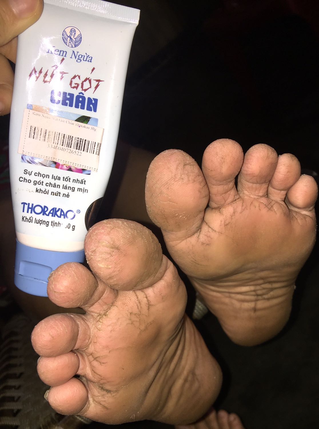Mẹ mình mua hai kem nứt gót của Thorakao trên tiki ngày 21-12-2019.Ngày 23-12-2019 đã nhận được hàng , hàng hóa được bao bì cẩn thận ,đánh giá sự phục vụ bên bộ phận giao hàng của tiki là 5 sao?
Lúc đầu da chân của mẹ mình rất sần sùi,vì mùa đông nên càng nứt đến nỗi chảy máu.Mình vô tình search sản phẩm của Thorakao thì biết đến sản phẩm này.Sau hơn 10 ngày sử dụng mẹ mình nói rằng da chân mịn hơn,không còn nứt nẻ đến chảy máu nữa,nói chung là xài nhiều sản phẩm và cách trị nứt gót mà chưa thấy sản phẩm nào tốt bằng cái này.Kem thơm,giá bình dân vì là hãng của VN ,hiệu quả cao.Để mẹ mình xài hết hai tuýp mình review ảnh cho mọi người xem tiếp nhe❤️Review mình chân thật,không giả dối nha. Mẹ mình mua hai kem nứt gót của Thorakao trên tiki ngày 21-12-2019.Ngày 23-12-2019 đã nhận được hàng , hàng hóa được bao bì cẩn thận ,đánh giá sự phục vụ bên bộ phận giao hàng của tiki là 5 sao?
Lúc đầu da chân của mẹ mình rất sần sùi,vì mùa đông nên càng nứt đến nỗi chảy máu.Mình vô tình search sản phẩm của Thorakao thì biết đến sản phẩm này.Sau hơn 10 ngày sử dụng mẹ mình nói rằng da chân mịn hơn,không còn nứt nẻ đến chảy máu nữa,nói chung là xài nhiều sản phẩm và cách trị nứt gót mà chưa thấy sản phẩm nào tốt bằng cái này.Kem thơm,giá bình dân vì là hãng của VN ,hiệu quả cao.Để mẹ mình xài hết hai tuýp mình review ảnh cho mọi người xem tiếp nhe❤️Review mình chân thật,không giả dối nha.