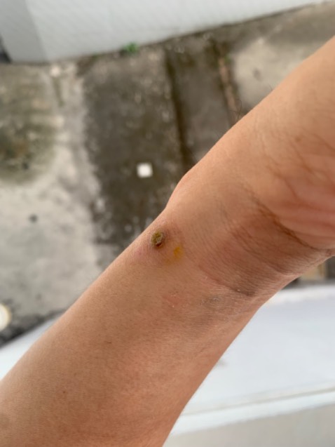 Giá rẻ, hiệu quả cao. Bạn cần kiên nhẫn trong 4 ngày, dùng tăm bông chấm dung dịch vào giữa mụn cóc, tránh để loang ra. Chờ khô 3-4p, chấm thêm lần nữa. Mỗi ngày sáng chiều là đủ. Đến ngày 3 là chúng bắt đầu rụng, cạy sạch sẽ ra. 
Sau khi cóc đi, dùng nước muối và nghệ để tái tạo da