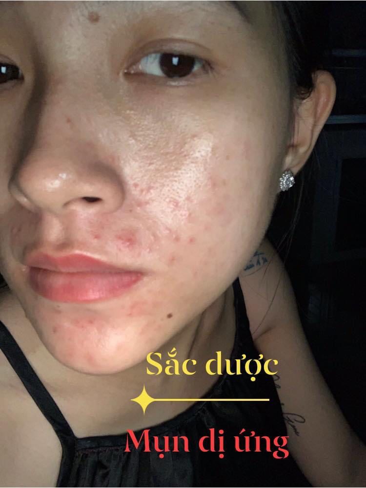sorry shop nhé. hình ảnh không liên quan. Anh chị em nào bị mụn, nám, sạm, da xấu xí mà chưa tìm dc cách điều trị hiệu quả thì liên hệ em nhé
☎️ *** Zalo, fb 
- Đảm bảo hết mụn 100%, không hết mụn hoàn tiền.