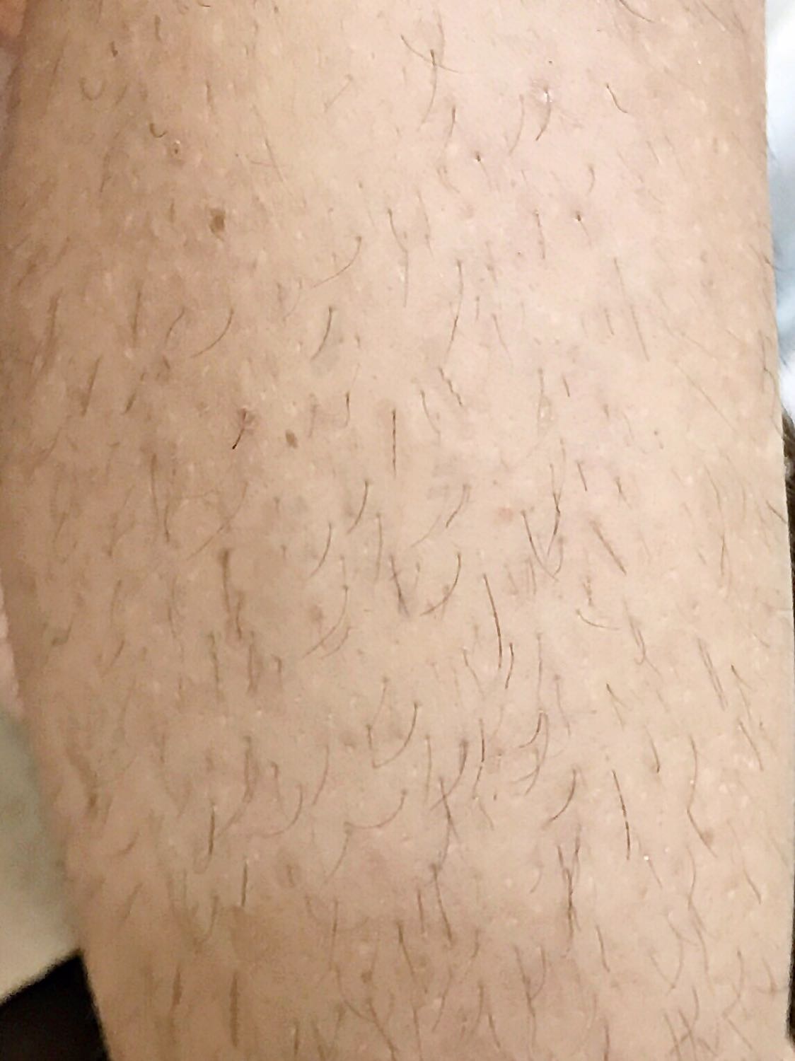 Lần đầu tiên tẩy lông tại nhà mà thấy đi hết được nang lông thế này. Cho tuýp vào lò vi sóng quay, lăn sáp lên chân rồi áp giấy vào, giật phát đi hết cả mảng lông nhìn rõ cả nang lông luôn. Lăn bằng con lăn tiện, sáp trải mỏng đều dễ làm dã man. Chân mình lông khá nhiều và cứng, trước dùng sáp lạnh giật mãi mới đi mà toàn thấy đứt chân. Tiền nào của nấy, đáng tiền. Nhưng các bạn nên mua cả dầu rửa sau tẩy lông để lau sáp dính, mình quên không mua, dùng dầu khác lau vẫn không sạch hết được. Sẽ ủng hộ nữa.