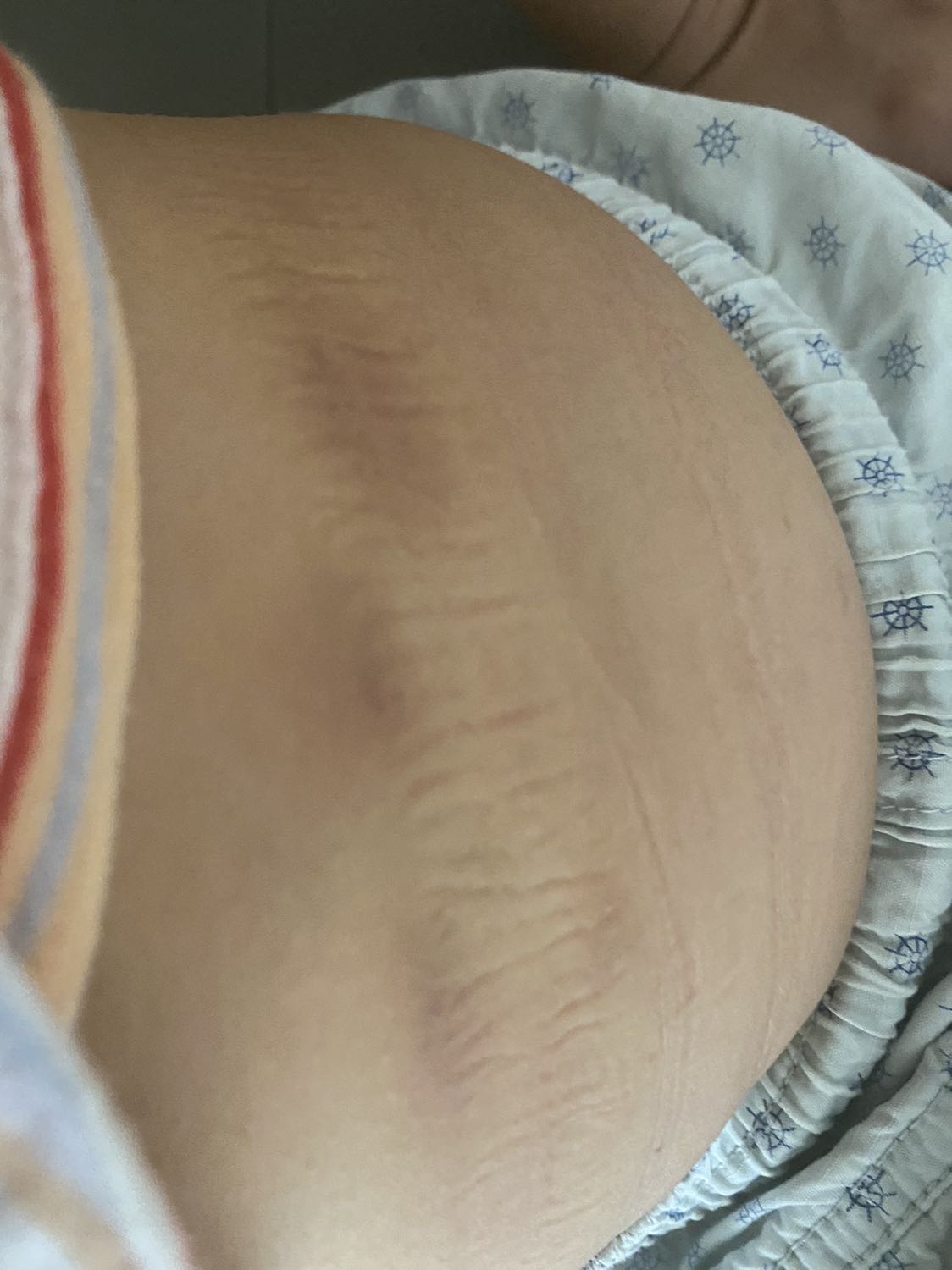 Vòng chắc dễ tháo lắp nhưng lắt đau lắm bầm tím hết cả cái hông mọi người cân nhắc trước khi mua nhé