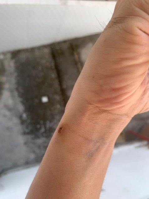 Giá rẻ, hiệu quả cao. Bạn cần kiên nhẫn trong 4 ngày, dùng tăm bông chấm dung dịch vào giữa mụn cóc, tránh để loang ra. Chờ khô 3-4p, chấm thêm lần nữa. Mỗi ngày sáng chiều là đủ. Đến ngày 3 là chúng bắt đầu rụng, cạy sạch sẽ ra. 
Sau khi cóc đi, dùng nước muối và nghệ để tái tạo da