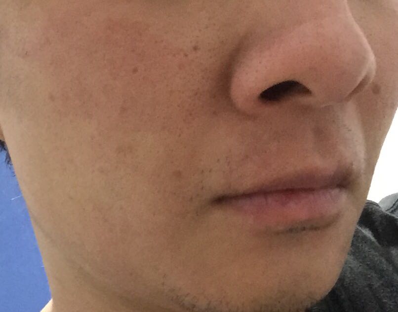 Khẩu trang gây cảm giác nóng, rát, làm da mặt bị mẫn đỏ (những chổ tiếp xúc) chỉ sau chưa đầy 10s đeo. Tôi đã gọi lên số tổng đài công ty Wakamonobio là *** thì được phản hồi là có khách hàng gặp dị ứng tương tự! Wakamono nên ghi kèm cụ thể phản ứng/dị ứng đối với da nhạy cảm. Bản thân tôi và gia đình sẽ không dùng lại sản phẩm này.