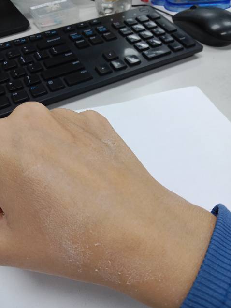 Mình đã sửa từ một sao lại thành năm sao.
Lúc đầu bôi lên 3 ngày liên tục da không có bong.
Chất kem thì hơi bết dính.
Bôi lên một tí thì nó khô, nhìn da rất quằn quại.
Tuy nhiên không nóng rát hay đỏ ửng hay ngứa gì cả.
Bây giờ thì ra đã bắt đầu bong nhé.
Phần da mới bong xong thì nó sáng hơn và mịn hơn.
Hài lòng nhé.