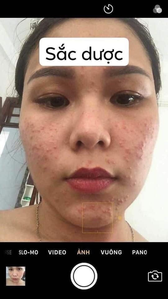 sorry shop nhé. hình ảnh không liên quan. Anh chị em nào bị mụn, nám, sạm, da xấu xí mà chưa tìm dc cách điều trị hiệu quả thì liên hệ em nhé
☎️ *** Zalo, fb 
- Đảm bảo hết mụn 100%, không hết mụn hoàn tiền.