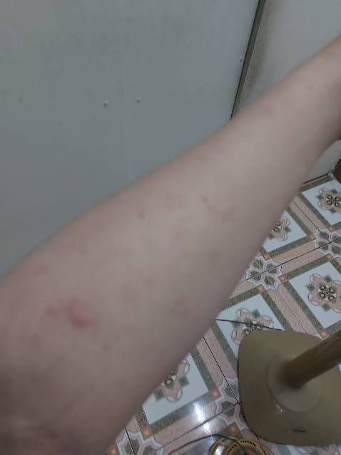 Sản phẩm nghi là hàng giả , sau khi uống vài ngày có hiện tượng nổi mẩn đỏ nhiều chỗ ở người , lúc đầu ko biết gì nên ngừng dùng 1 tuần sau khi dùng lại thì lại bắt đầu nổi như trước và chắc chắn là do thuốc , mong có sự phản hồi từ bên bán hàng về vấn đề chất lượng sản phẩm này.