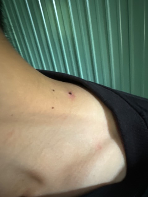 Đã dùng chấm vô mụt ruồi thịt khoản 2-3 lần/ngày 3 ngày là rụng da cháy kết vảy. Chờ lành