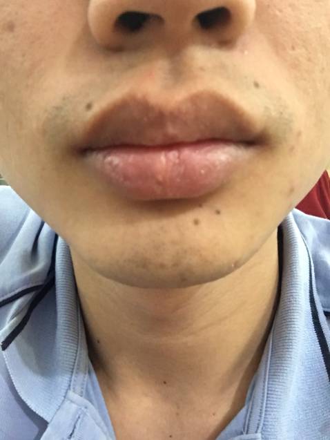 Sáng ra quên cạo râu, đến công ty order luôn 1 máy để xử lý tại chỗ.
99k Không đòi hỏi gì thêm. Có hơi rát chút nhé. Tương đương dùng lưỡi Gi lét kép đang dùng, mà máy không cần bọt. Khuyến khích rửa mặt trước và sau khi dùng máy và phải dùng khăn lau khô. Vì máy cạo râu khô sẽ hiệu quả hơn. À dùng nước ấm lại càng tốt hơn nhé. Thấy máy ở TOP 1 máy cạo râu bán chạy trên Tiki và mua rồi thấy nó xứng đáng thực sự. Cảm ơn shop, cảm ơn Tiki, cảm ơn các bố đã view chiếc review này của em.
Ai có kinh nghiệm chọn mua lưỡi thay thế thì chia sẻ cho mình nhé. Shop bán máy có lưỡi 45k (bằng giá máy 45+44=99k)