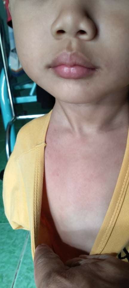 Trước giờ mình dùng thuần mộc tiếp nhỏ hơn, khi nhận của tiki mình lo lắng k biết phải hàng nhái hay k, nên chưa phản hồi sản phẩm, tuy nhiên sau 3 ngày khi bôi thuần mộc thì mình thấy của tiki bán sản phẩm tốt, bé mình bị ngứa quanh cổ, xoa vào đã lặn vết ngứa đỏ. Sẽ tiếp tục ủng hộ tiki