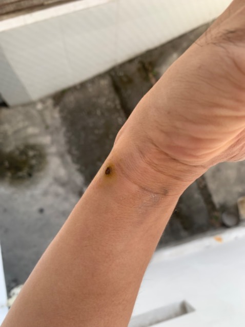 Giá rẻ, hiệu quả cao. Bạn cần kiên nhẫn trong 4 ngày, dùng tăm bông chấm dung dịch vào giữa mụn cóc, tránh để loang ra. Chờ khô 3-4p, chấm thêm lần nữa. Mỗi ngày sáng chiều là đủ. Đến ngày 3 là chúng bắt đầu rụng, cạy sạch sẽ ra. 
Sau khi cóc đi, dùng nước muối và nghệ để tái tạo da