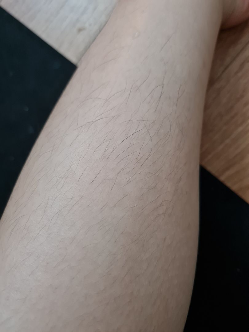 nhìn chung là sau 1 tháng thì lông mọc thưa hơn và chậm hơn, nhưng mình có hiện tượng lông bị mọc ngược