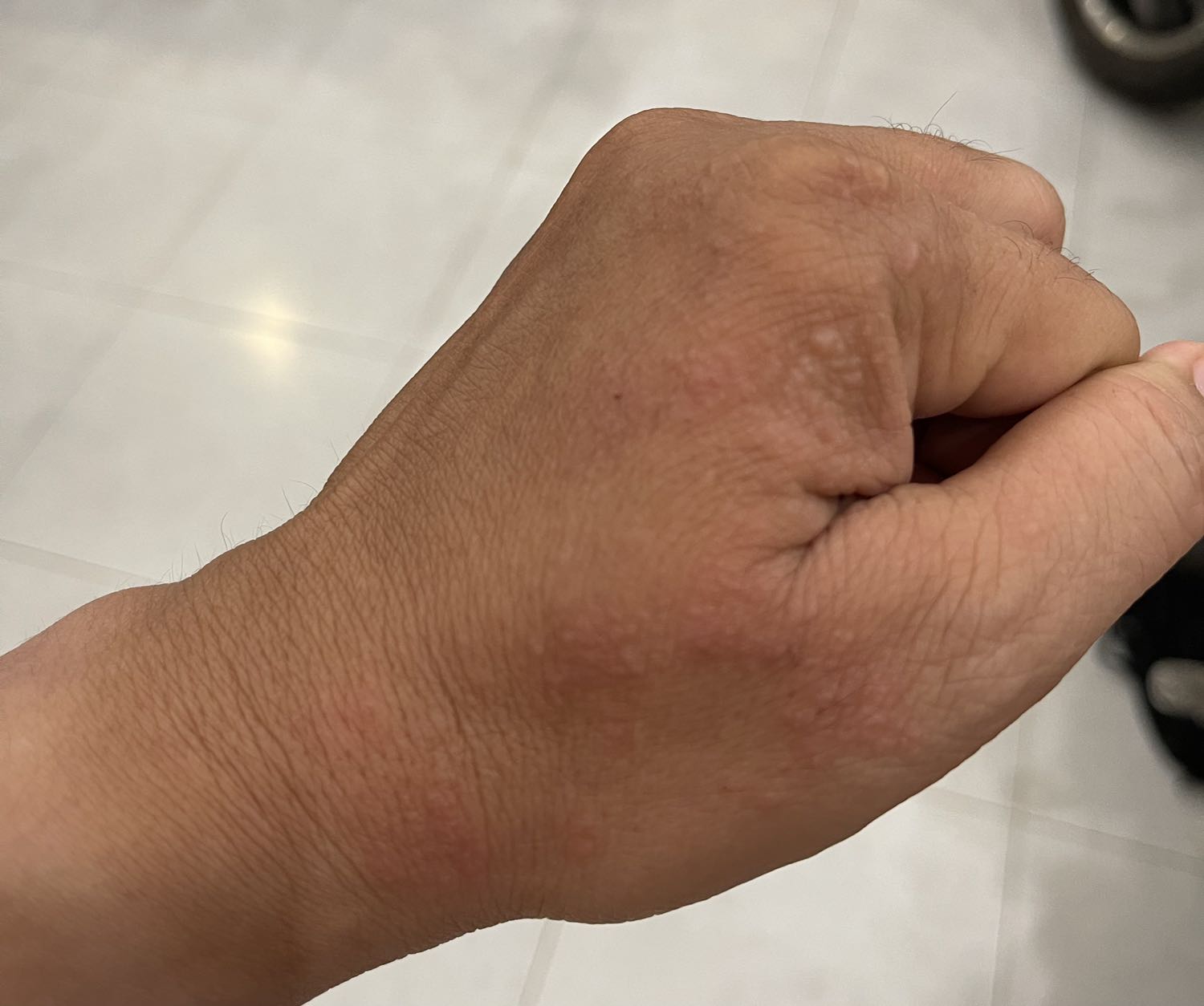 Dù rất cẩn thận nhưng vẫn bị dính 1 chút xíu mà cái tay nỗi mụn nước ngứa vô cùng, lần đầu mình bị nặng hơn. Rất đáng sợ