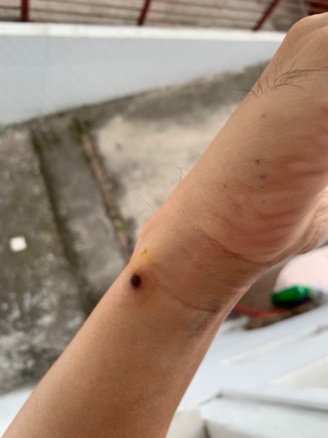 Giá rẻ, hiệu quả cao. Bạn cần kiên nhẫn trong 4 ngày, dùng tăm bông chấm dung dịch vào giữa mụn cóc, tránh để loang ra. Chờ khô 3-4p, chấm thêm lần nữa. Mỗi ngày sáng chiều là đủ. Đến ngày 3 là chúng bắt đầu rụng, cạy sạch sẽ ra. 
Sau khi cóc đi, dùng nước muối và nghệ để tái tạo da