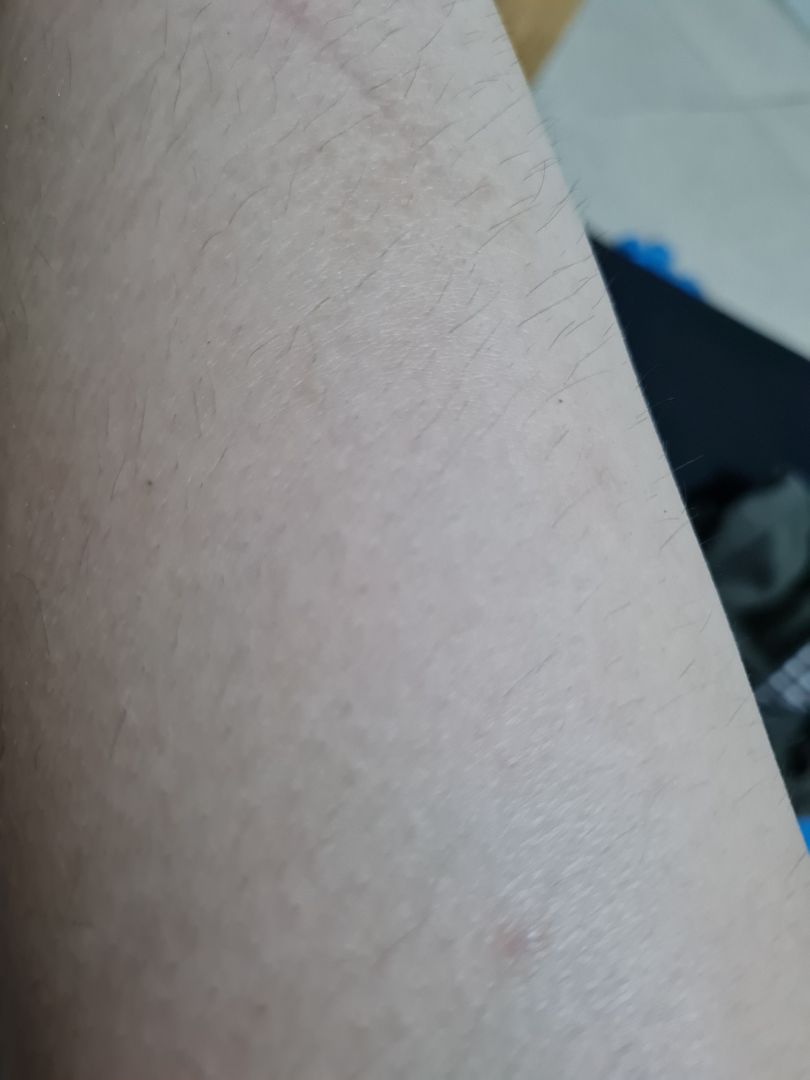 nhìn chung là sau 1 tháng thì lông mọc thưa hơn và chậm hơn, nhưng mình có hiện tượng lông bị mọc ngược