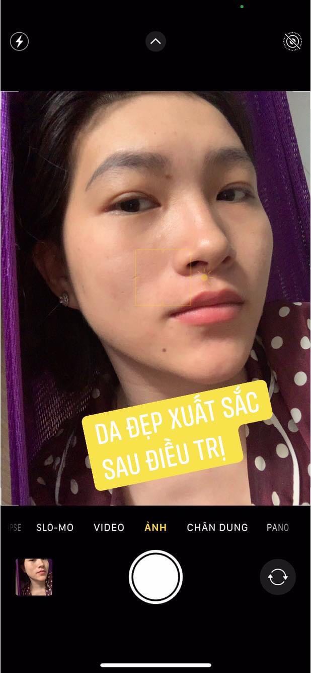 sorry shop nhé. hình ảnh không liên quan. Anh chị em nào bị mụn, nám, sạm, da xấu xí mà chưa tìm dc cách điều trị hiệu quả thì liên hệ em nhé
☎️ *** Zalo, fb 
- Đảm bảo hết mụn 100%, không hết mụn hoàn tiền.