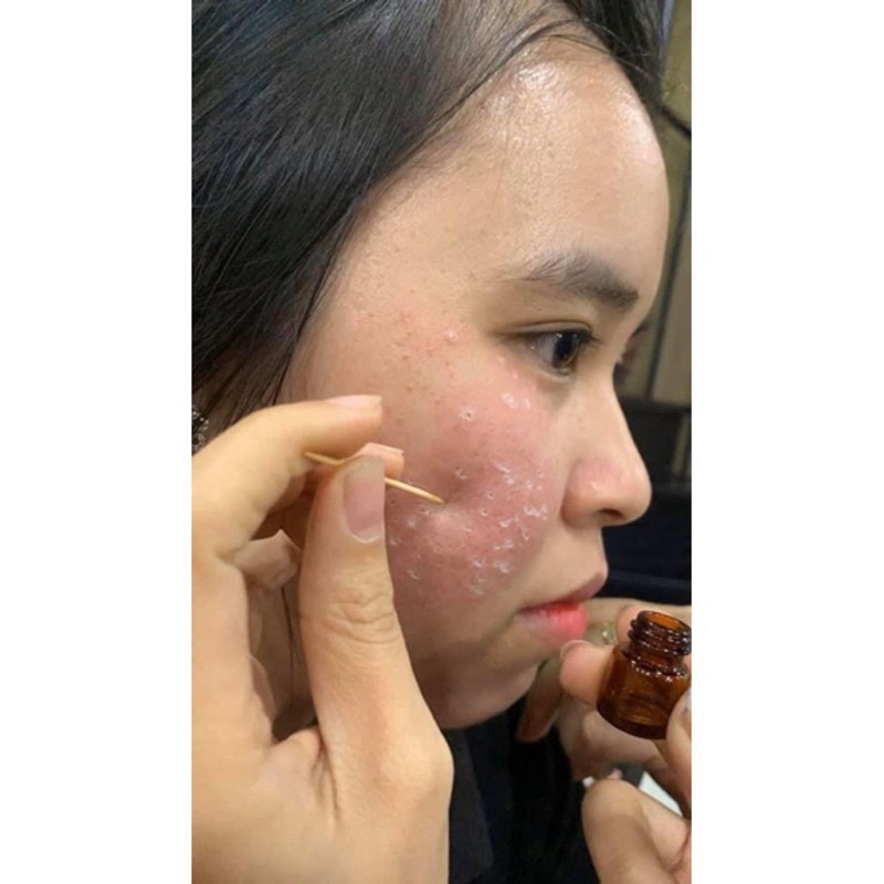 Chấm tàn nhang nám rỗ yody white phương anh - lọ 2ml