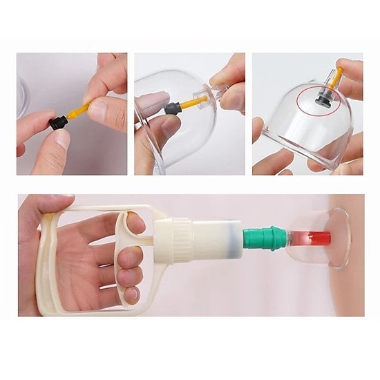 Bộ Dụng Cụ Giác Hơi Không Dùng Lửa 24 Ly Cao Cấp - Hàng Chính Hãng