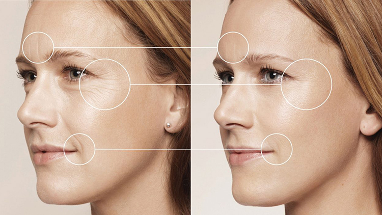 Trọn Gói 5 Lần Max Burn Lipo Giải Pháp Hoàn Hảo Sở Hữu Đường Cong Chuẩn S Line - Công Nghệ Độc Quyền Tại Hương Tre Clinic & Spa