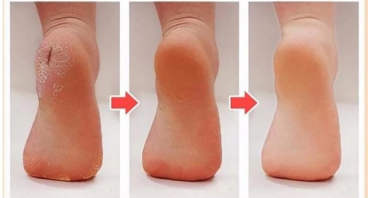 Bộ 3 đôi vớ Silicon bảo vệ gót chân và cổ chân