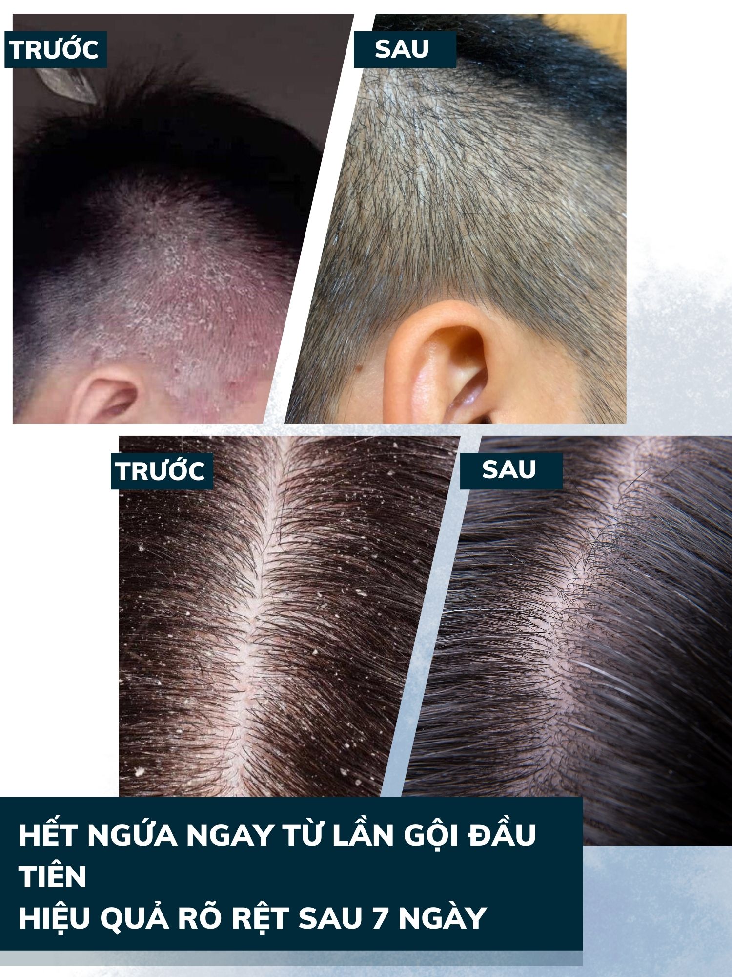 Dego Pharma - Dầu gội sạch vảy gàu mảng trắng, hết ngứa chiết xuất thiên nhiên từ vỏ cây Zizyphus, sản xuất theo tiêu chuẩn và dưới sự giám sát của công ty dược phẩm Châu Âu (80ml)