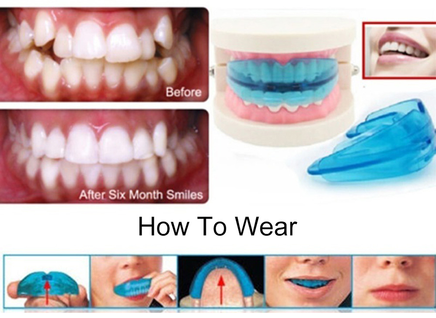 Dụng Cụ Niềng Răng Chỉnh Nha Tại Nhà