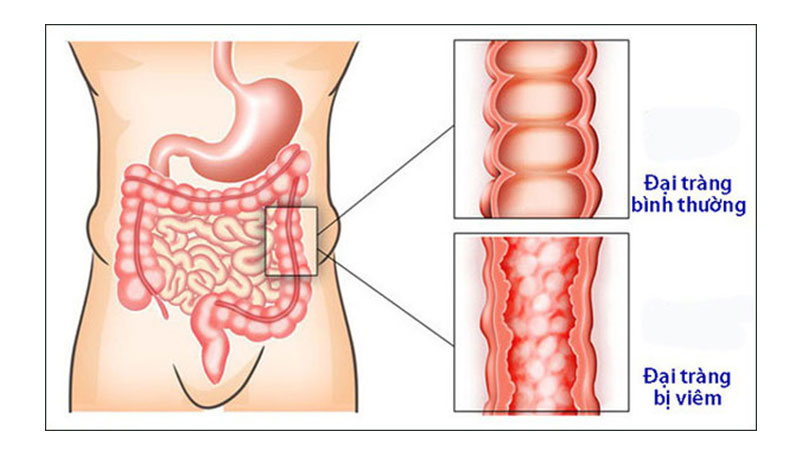 Đại Tràng Rox giảm rối loạn tiêu hóa, co thắt đại tràng Hộp 60 viên