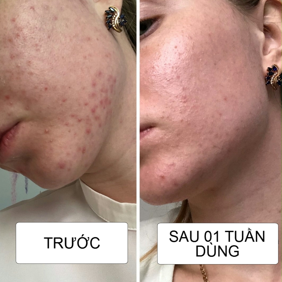 review hieu qua kem tri mun sos