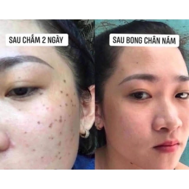 Chấm tàn nhang nám rỗ yody white phương anh - lọ 2ml