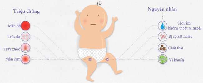 trẻ bị hăm do tã