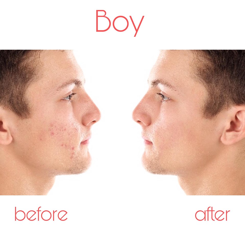 Tinh Chất Giảm Mụn, Mờ Thâm 24h Nam Nữ -Anti Acnes Pro Myloky 9