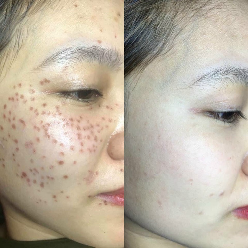 Chấm tàn nhang nám rỗ yody white phương anh - lọ 2ml