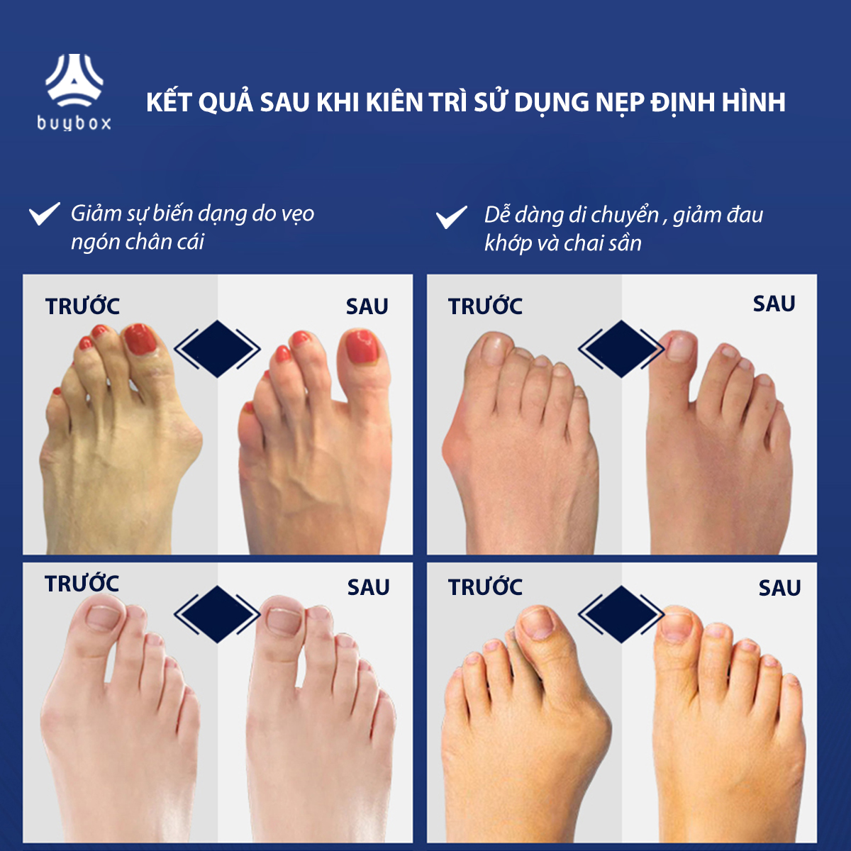 Combo 2 cặp dụng cụ chỉnh hình, bảo vệ ngón chân cái bị vẹo chất liệu nhựa PC và silicone - Buybox