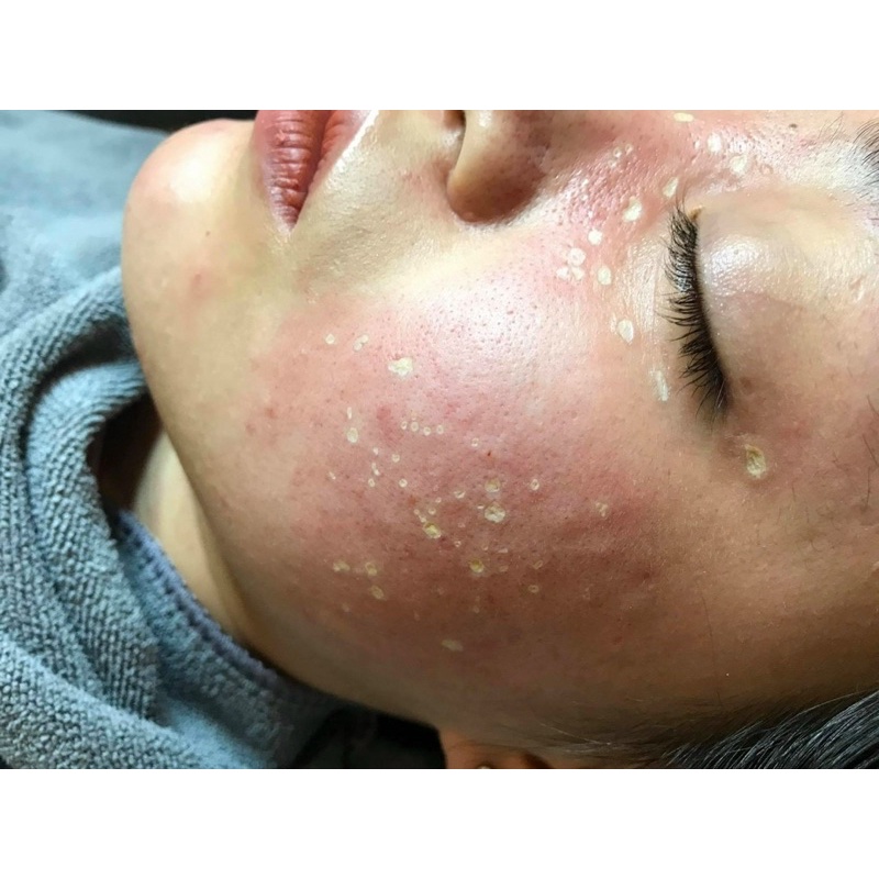 Chấm tàn nhang nám rỗ yody white phương anh - lọ 2ml